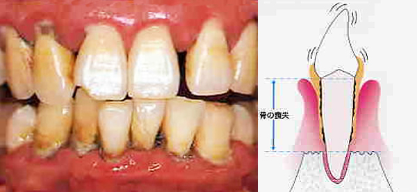重度歯周炎