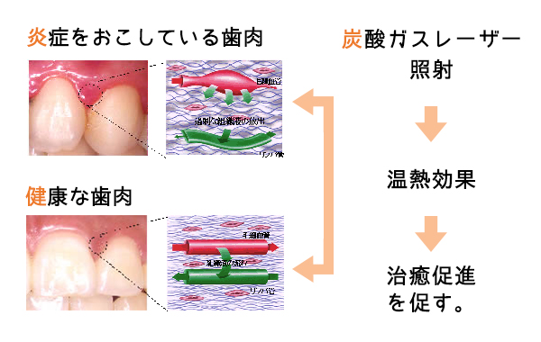 歯周病の治療