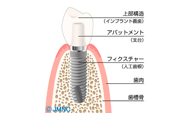 インプラントの特徴